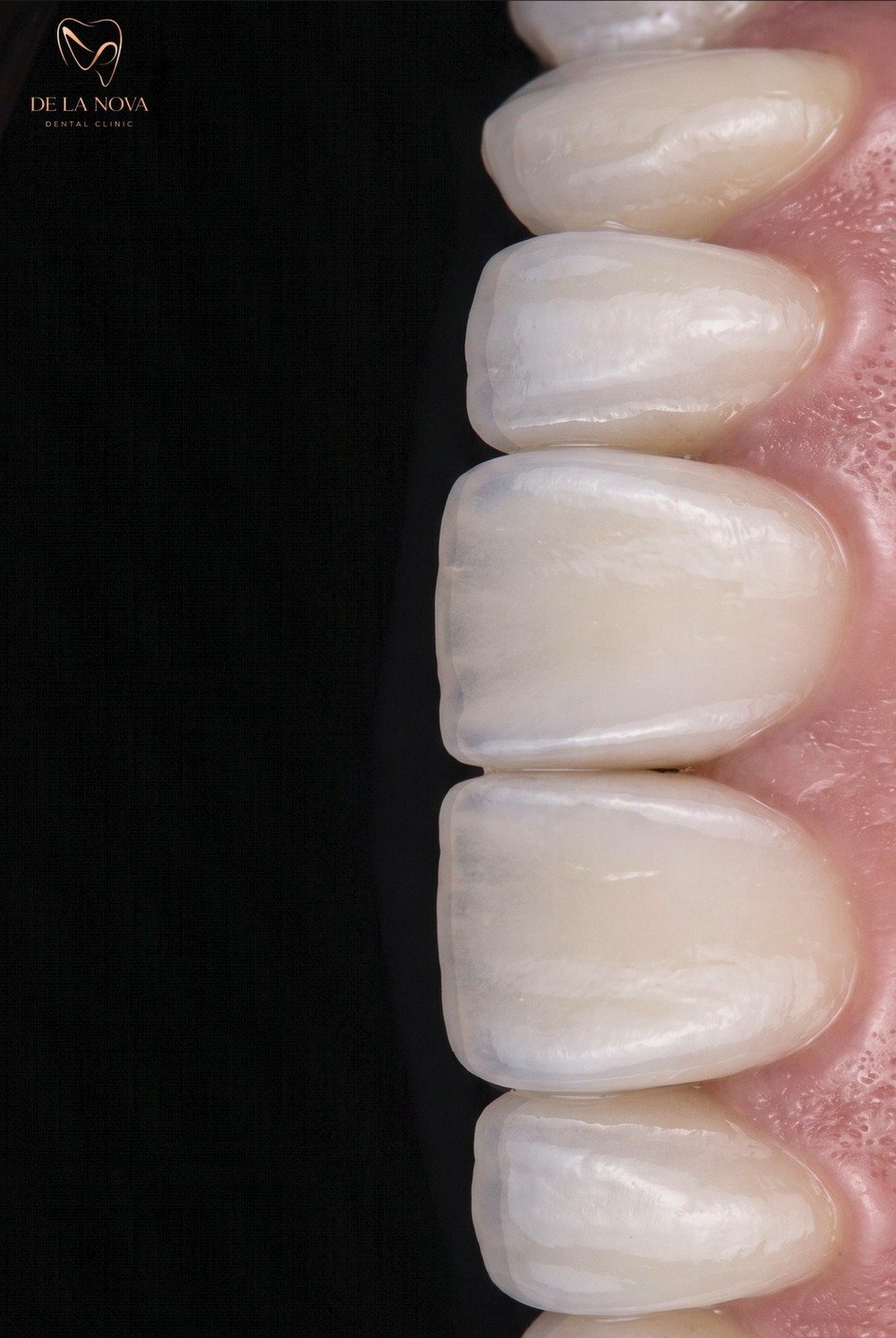 Veneers result, De La Nova Clinic